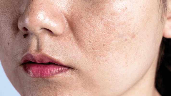 Biểu hiện da mất nước